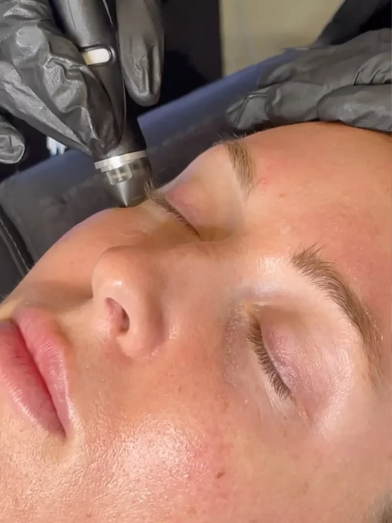 Women getting hydrodermabrasion treatment