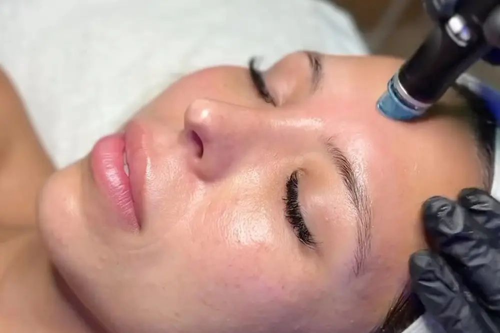 Patient being treated with hydrafacial treatment in los angeles