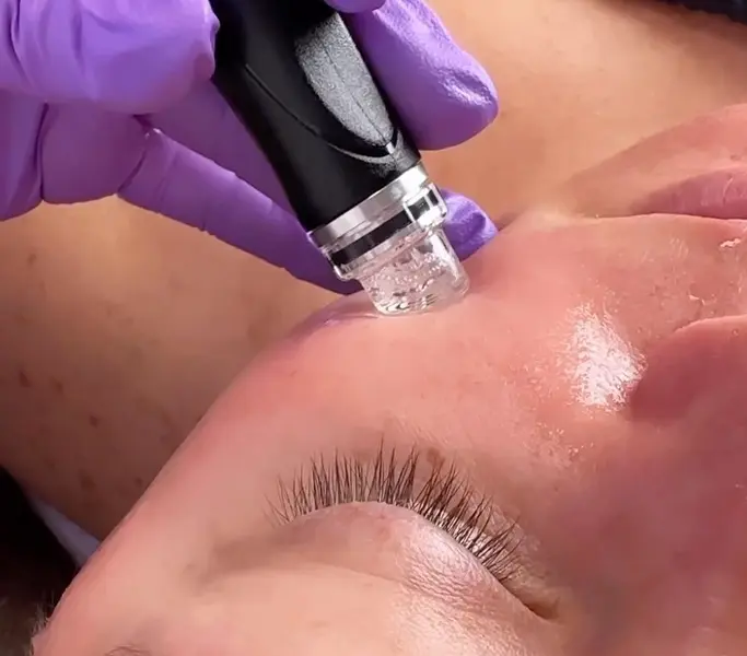 Hydrafacial before and after visible results