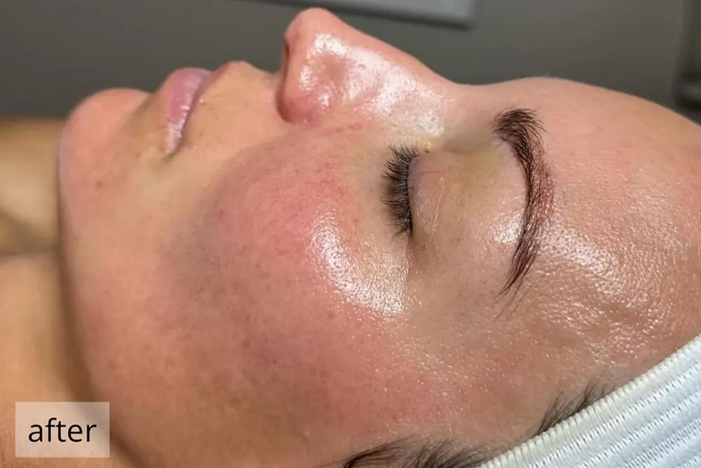 Before and After: Woman's Skin Transformation After Diamond Glow Hydrafacial Treatment by Carla Cohen